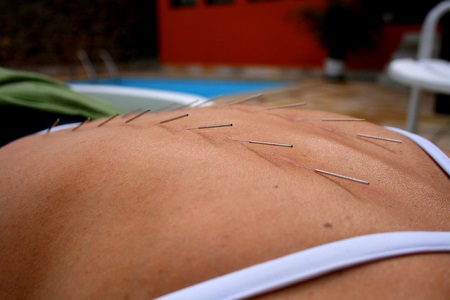 Back Acupuncture